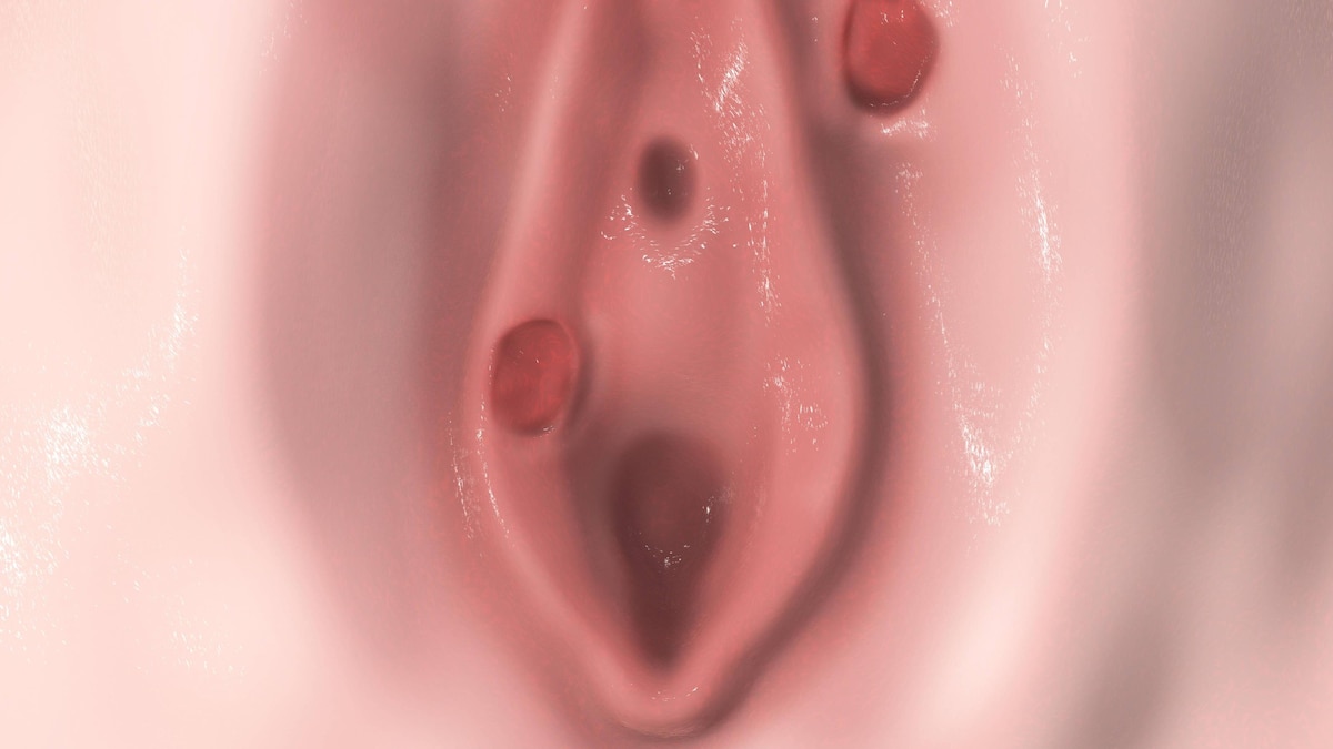 Female syphilis, illustration Syphilis ulcer on vulva, computer illustration. PUBLICATIONxNOTxINxUKxFRAxUSAxCAN KATERYNAxKON SCIENCExPHOTOxLIBRARY F016 3560